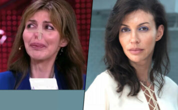 Проблеми з носом у джексона і казьміної через невдалу пластику: хірург пояснив, як можна врятувати екс-дружину аршавіна